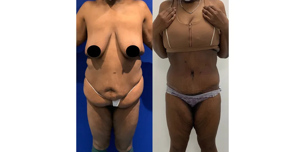 Before And After Of Abdominoplasty Patient