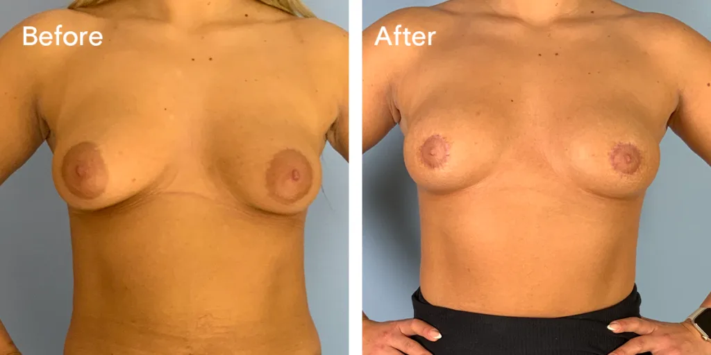 Patient before and after areola reduction