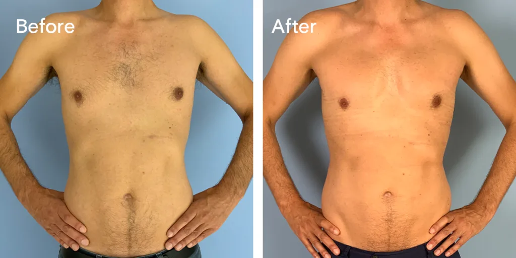 Patient Before And After Pectoral Implants