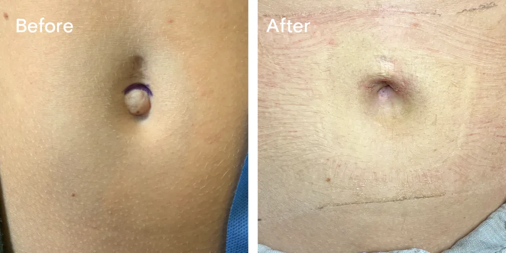 patient before and after umbilical hernia repair