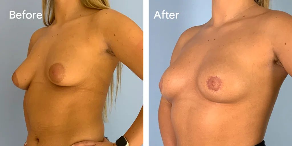 Patient Before And After Areola Reduction