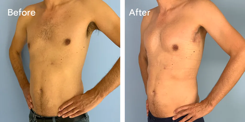 Patient Before And After Pectoral Implants