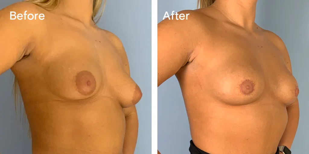 Patient Before And After Areola Reduction