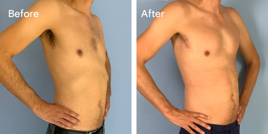 Patient Before And After Pectoral Implants