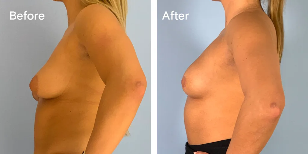 Patient Before And After Areola Reduction