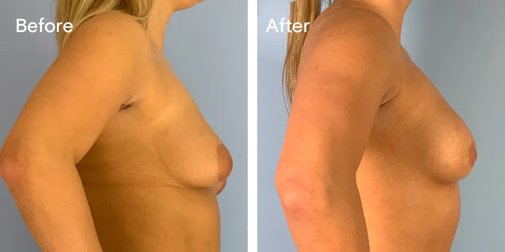 Patient Before And After Areola Reduction