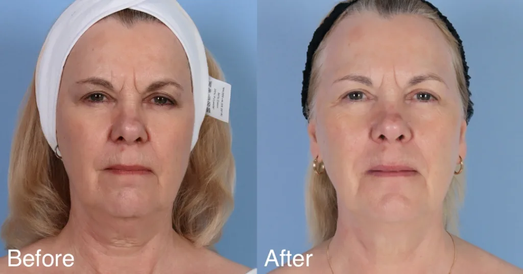 Patient Before And After 2 Sessions Of Fotona 4D