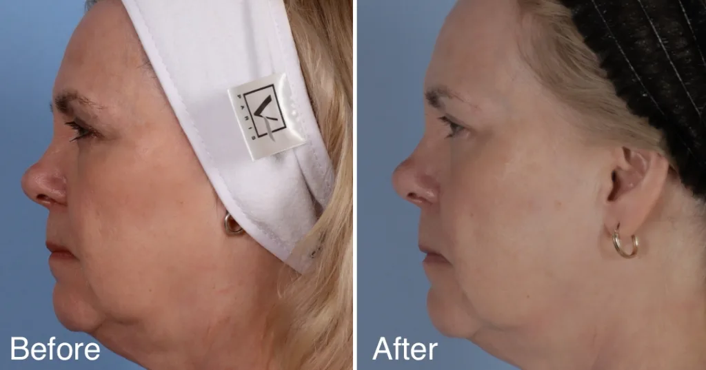 Fotona 4D Laser Facelift London