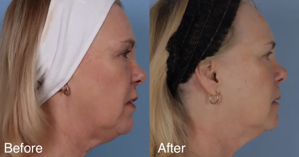 Patient Before And After 2 Sessions Of Fotona 4D