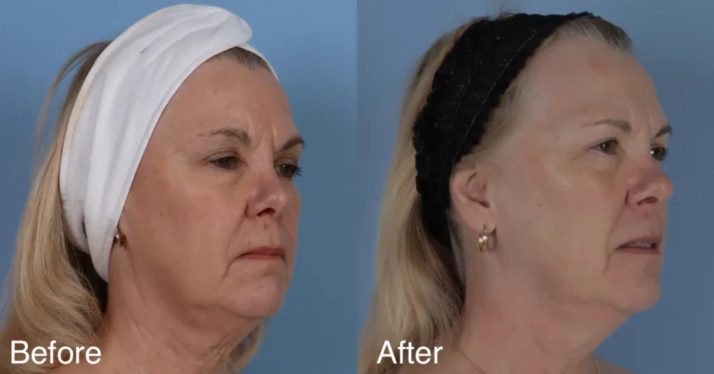 Patient Before And After 2 Sessions Of Fotona 4D