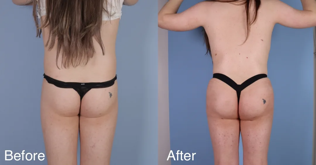 Patient Before And After Bbl
