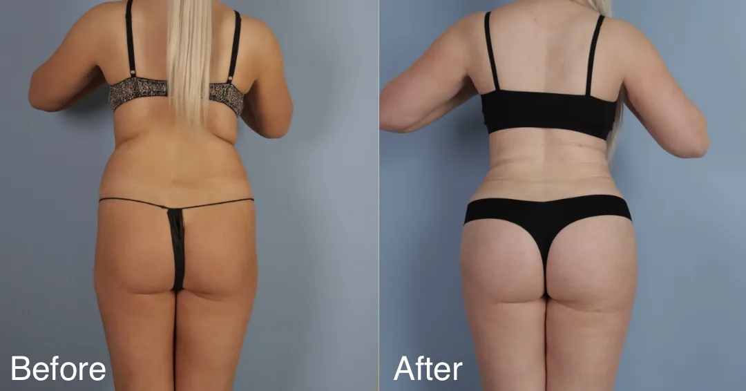 Patient Before And After Brazilian Butt Lift