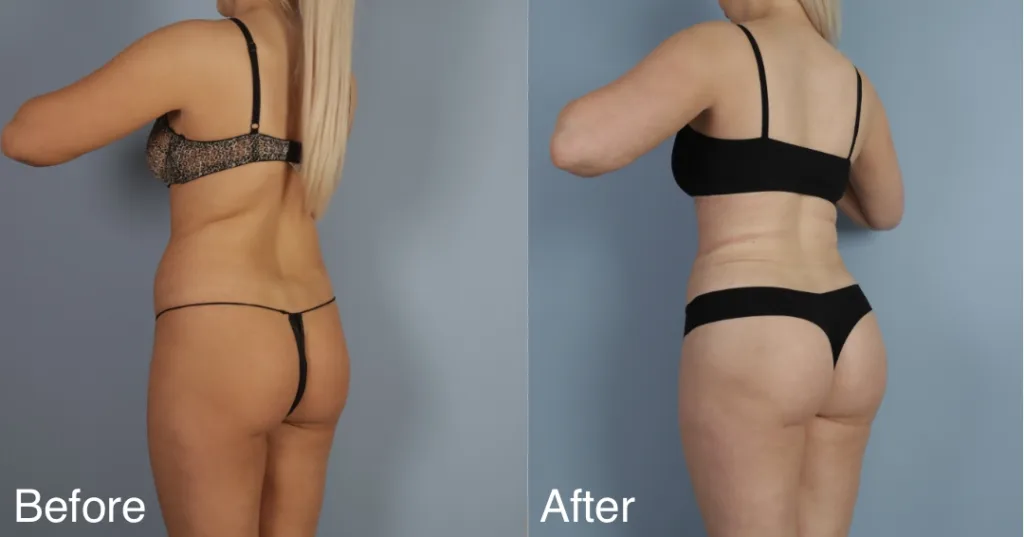 patient before and after brazilian butt lift