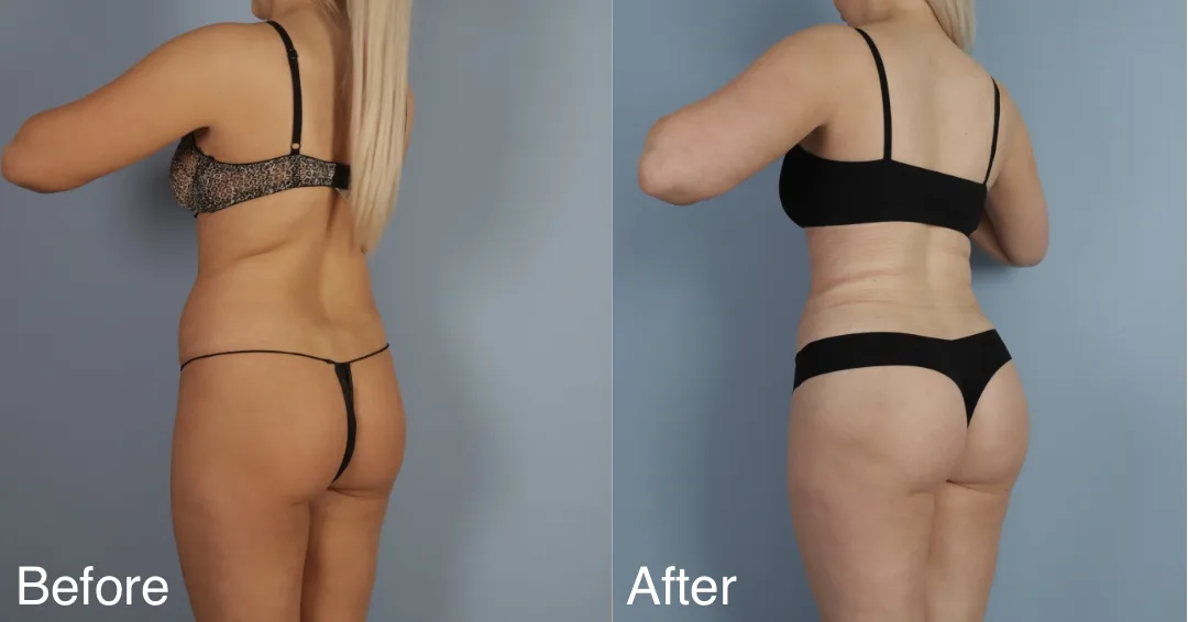 Patient Before And After Brazilian Butt Lift