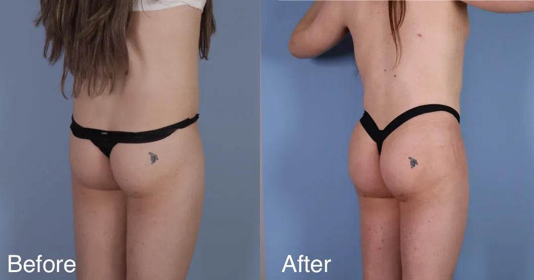 Patient Before And After Bbl