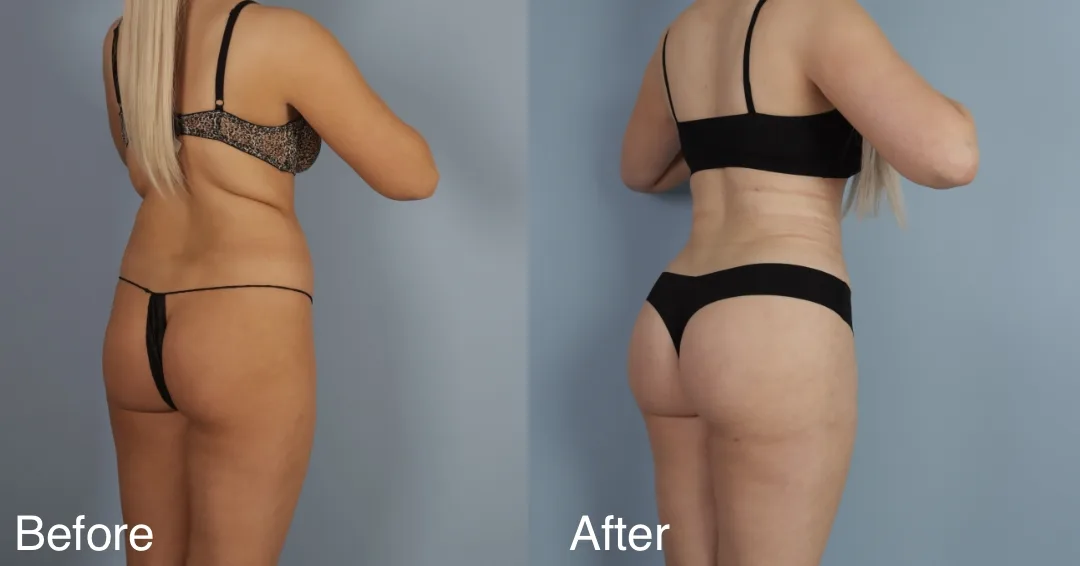 Patient Before And After Brazilian Butt Lift