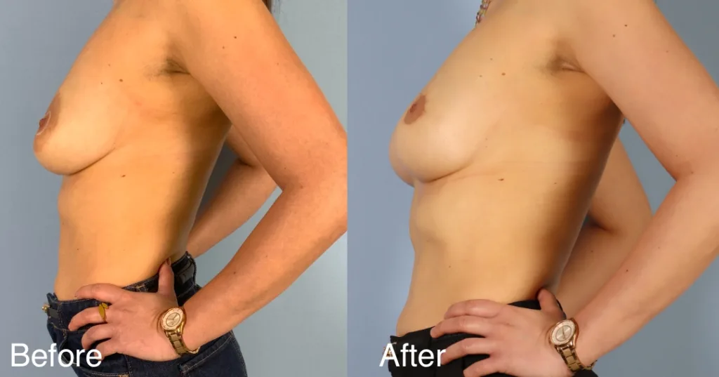 woman before and after areola reduction