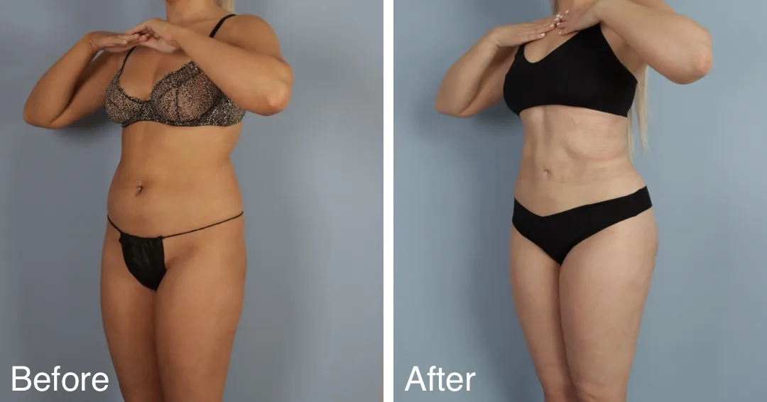Patient Before And After Brazilian Butt Lift
