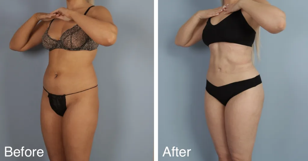 patient before and after brazilian butt lift