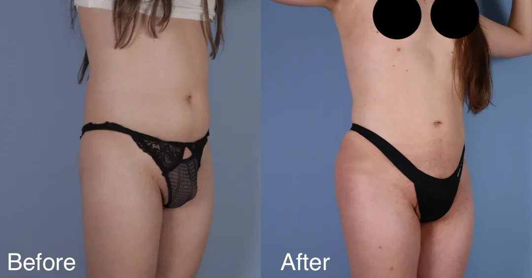 Patient Before And After Bbl