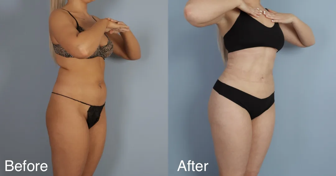 Patient Before And After Brazilian Butt Lift