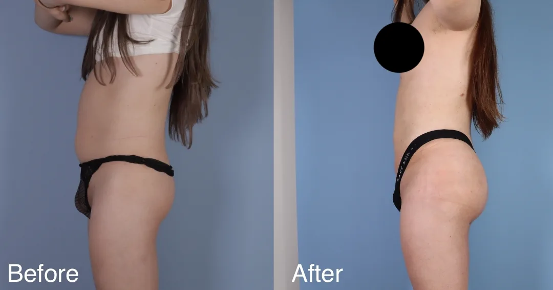 Patient Before And After Bbl