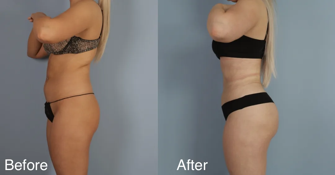 Patient Before And After Brazilian Butt Lift