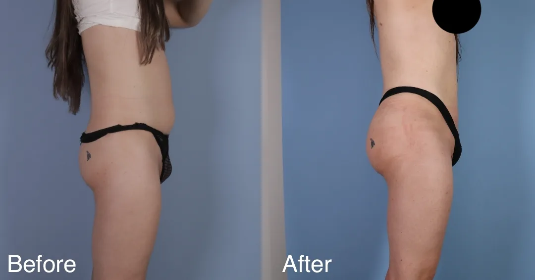 Patient Before And After Bbl