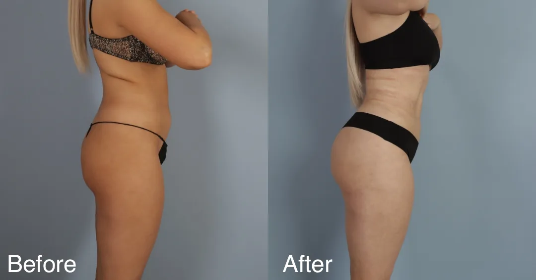Patient Before And After Brazilian Butt Lift