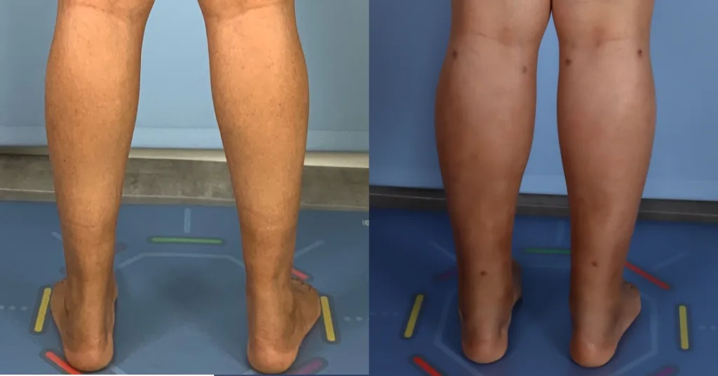 a patient before and after fat transfer calf augmentation