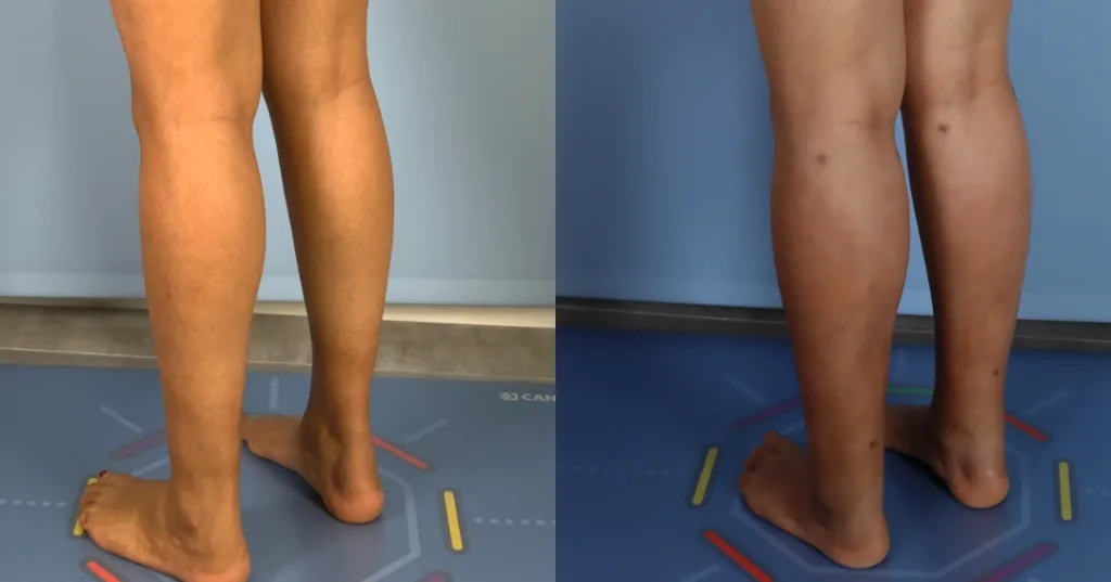 a patient before and after fat transfer calf augmentation