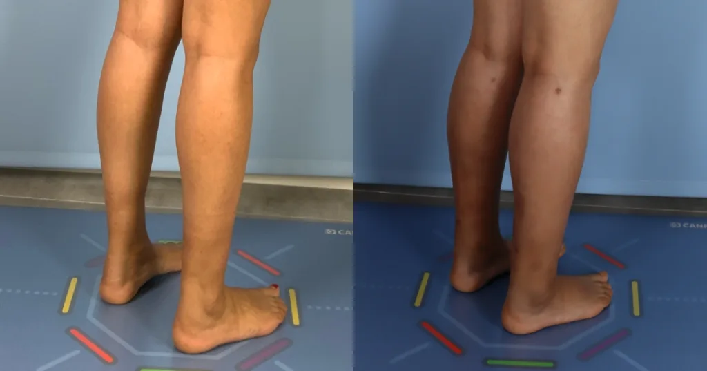 a patient before and after fat transfer calf augmentation