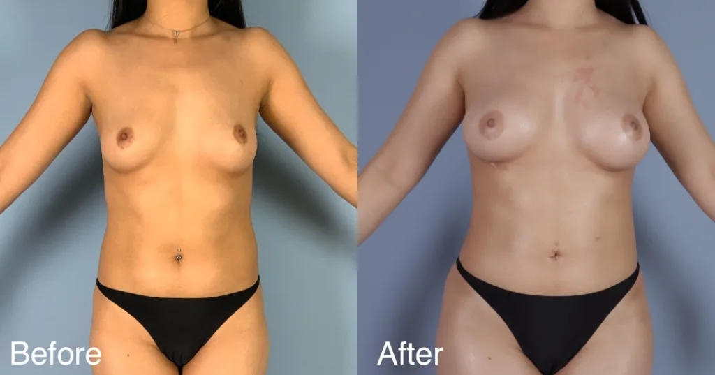 Patient Before And After Fat Transfer Breast Augmentation
