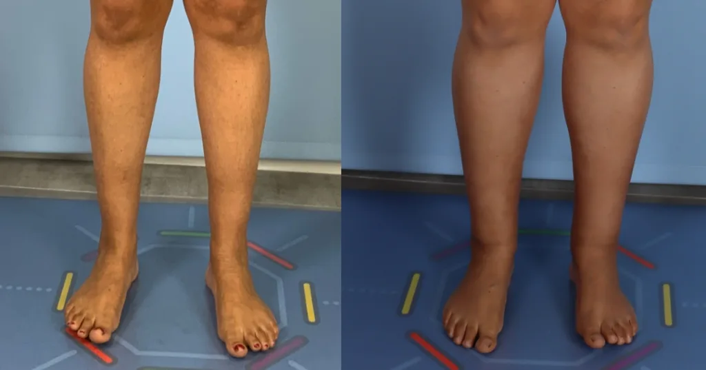 a patient before and after fat transfer calf augmentation