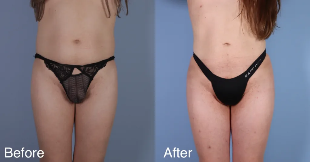 patient before and after BBL
