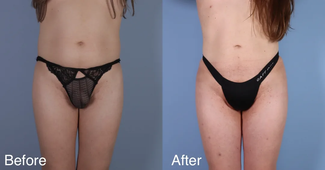 Patient Before And After Bbl