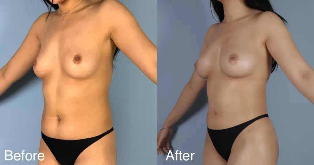 Patient Before And After Fat Transfer Breast Augmentation