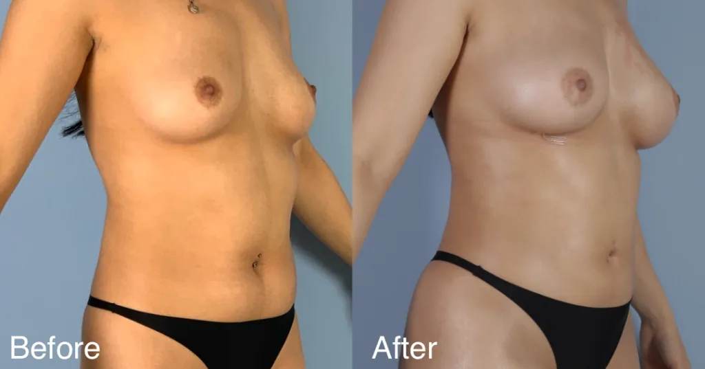 Patient Before And After Fat Transfer Breast Augmentation