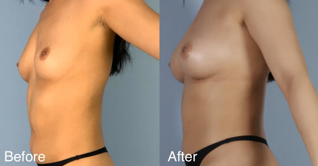 Patient Before And After Fat Transfer Breast Augmentation