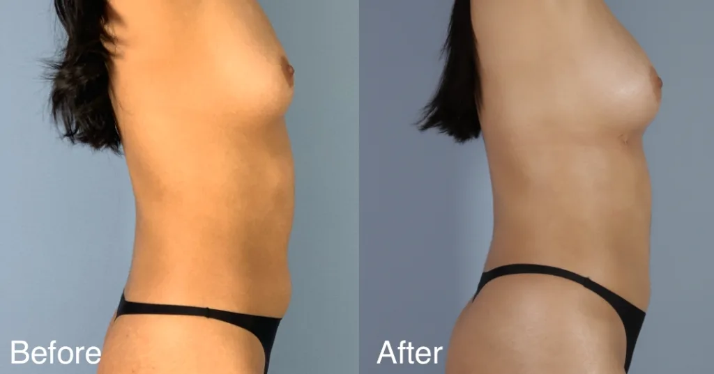 Patient Before And After Fat Transfer Breast Augmentation