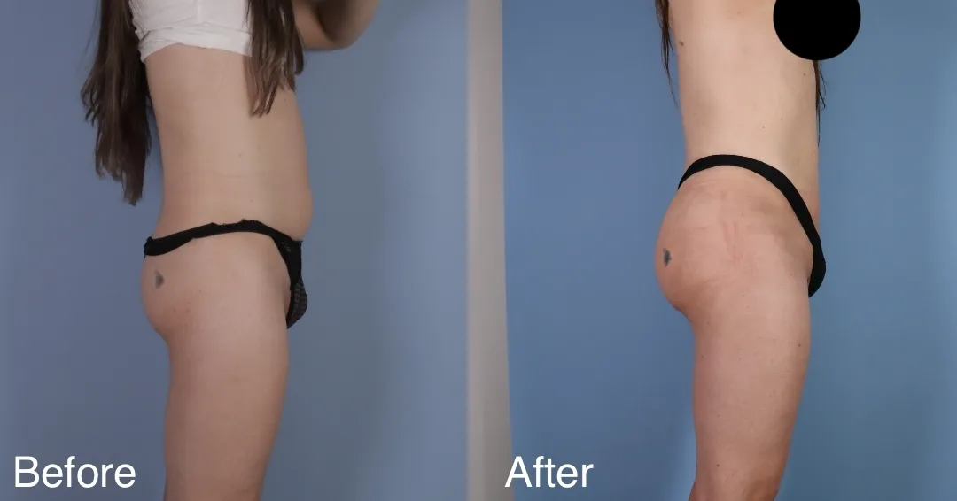 Brazilian Butt Lift (Bbl) London