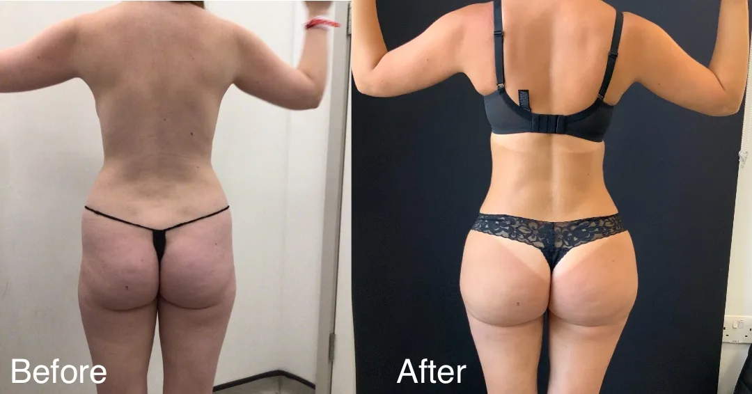 Patient Before And After A Bbl