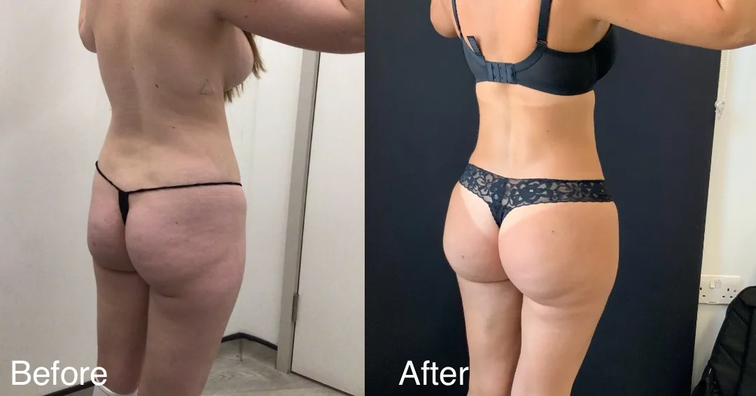 Patient Before And After A Bbl