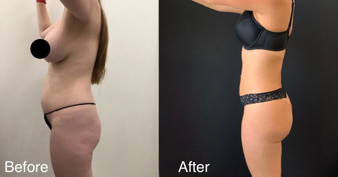 Patient Before And After A Bbl