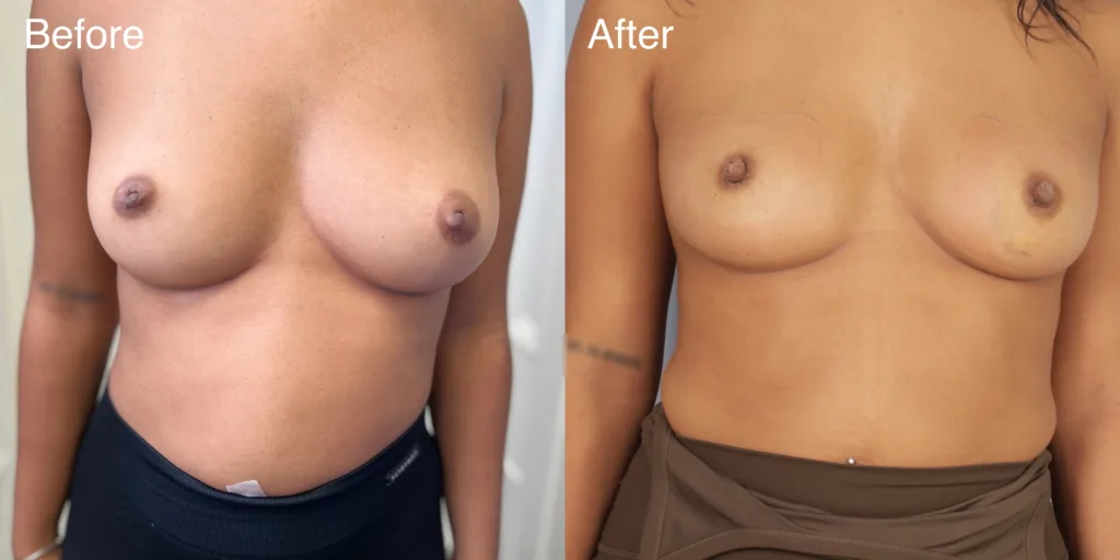 A Patient Before And After Nipple Correction Surgery