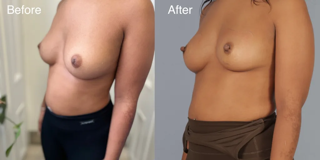 A Patient Before And After Nipple Correction Surgery