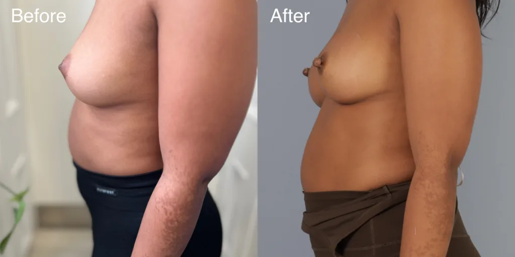 A Patient Before And After Nipple Correction Surgery