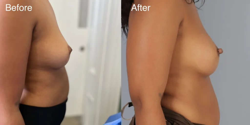 A Patient Before And After Nipple Correction Surgery