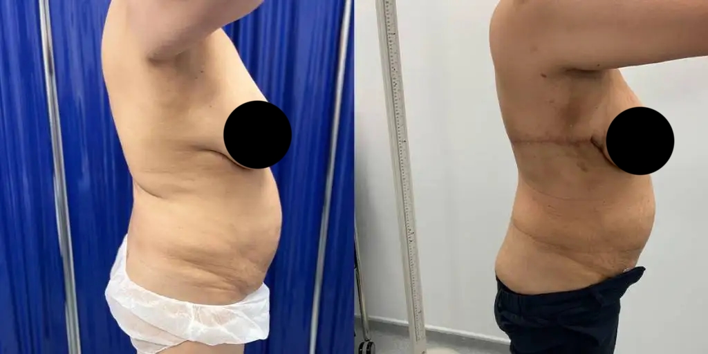 Before And After Bra Line Back Lift, Right View - Patient 1