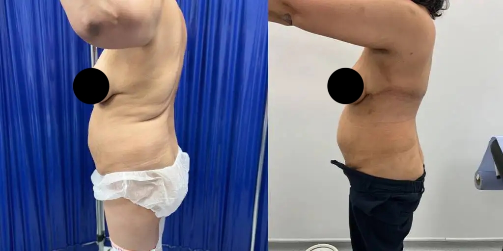 Before And After Bra Line Back Lift, Left View - Patient 1